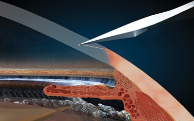 1765546413_Blade-Incisions