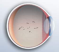 1765547152_Vitreous-Detachment